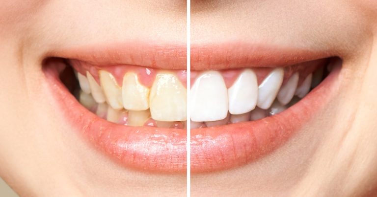 6,700 Shoppers Confirm This Is the Best Way to Whiten Teeth — In 2 Days