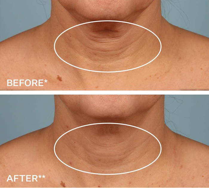 strivectin-before-after1