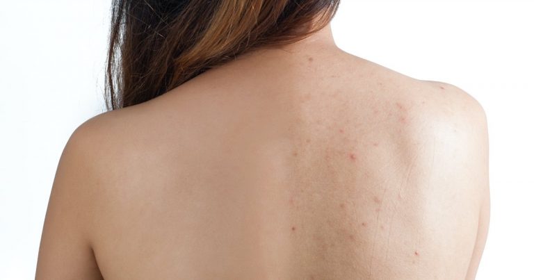 Help Control Back and Chest Acne With This Innovative Spray Treatment