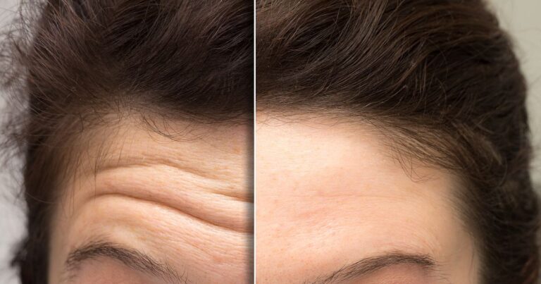 Better Than Botox? 7 of the Best Forehead Wrinkle Creams on the Market