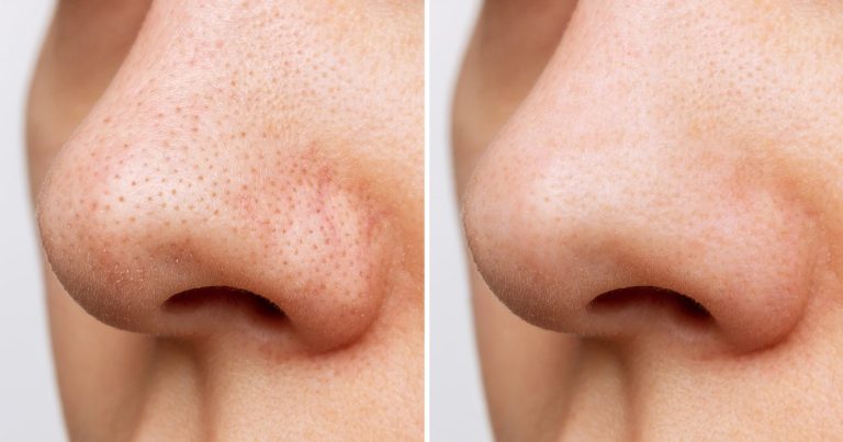 Bye Bye, Pores! This Serum Could Refine Skin Texture in Just 1 Week