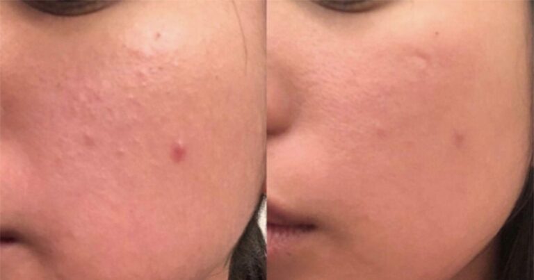 This Painless Derma Roller Is Producing Incredible Before and After Photos