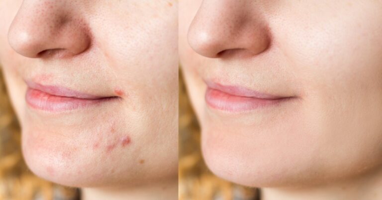 This Therapeutic Gel May Remove Acne Scars Dating Back to Your Teenage Years